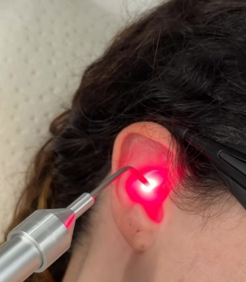 Aplicación de auriculoterapia con láser frío en el pabellón auricular